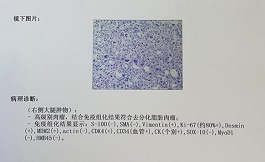 晚期脂肪肉瘤，美國專家給出了新方案