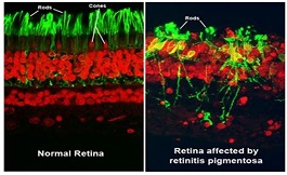 視網膜色素變性的病因、診斷與治療