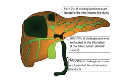 膽管癌二代靶向藥獲FDA 孤兒藥稱號