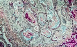 英國(guó)NHS批準(zhǔn)了晚期腸癌聯(lián)合免疫療法