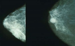 女性之間的乳腺癌死亡率差距縮小了