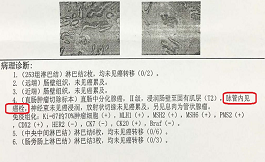 直腸癌術后要不要化療？