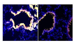 科學(xué)家找到了一種逆轉(zhuǎn)腫瘤免疫抑制的新方法