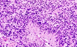 出國看病：研究表明凝膠增強了 CAR-T 免疫療法益處