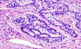 研究發現轉移性結直腸癌患者生存率相似