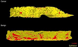 3D 成像可更好地確定前列腺癌的侵襲性