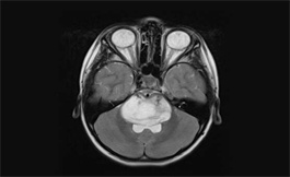 海外發現兒童侵襲性腦腫瘤的新靶點