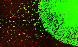 科學家開發出工程干細胞來治療侵襲性腦癌