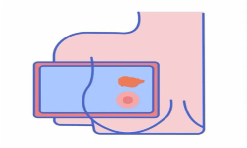 乳房活檢.png