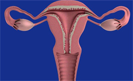 卵巢癌監測可診斷出 BRCA 基因有缺陷的女性
