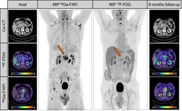 美國看病：Ga-68 FAPI PET 可改善胰腺癌檢測和分期