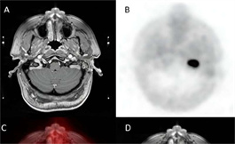 PET/CT 為頭頸部副神經節瘤提供了更好的病變檢測