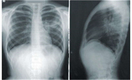 Nivolumab 加化療代表了非小細胞肺癌治療的未來！