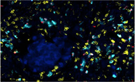 數據支持晚期腎細胞癌一線使用 Avelumab 加阿西替尼