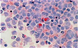 出國看病：胃癌的圍手術期 Durvalumab 加化療符合 EFS 終點