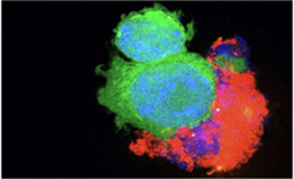 出國治療：Nivolumab 聯(lián)合可穿透黑色素瘤伴腦轉(zhuǎn)移的血腦屏障